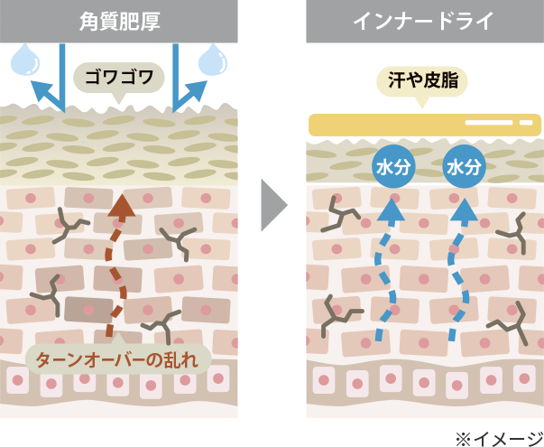 角質肥厚/インナードライのイメージ