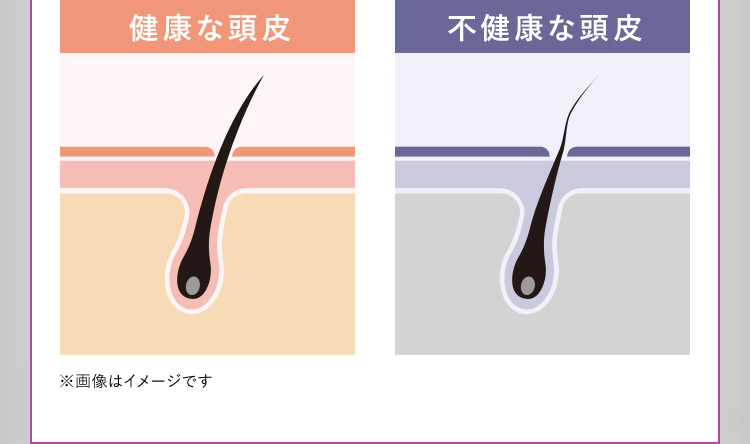 健康な頭皮 不健康な頭皮 ※画像はイメージです